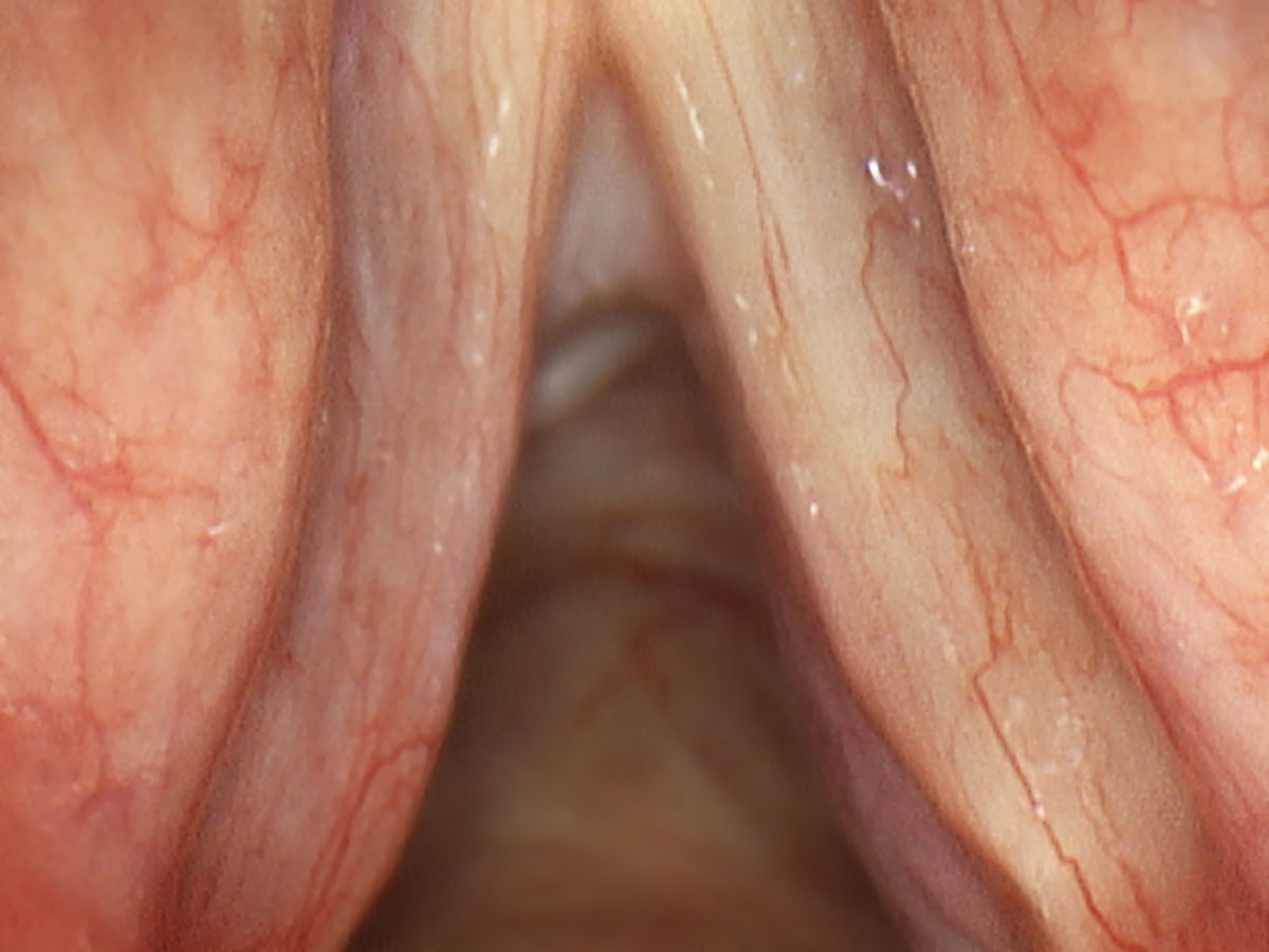 throat cancer 