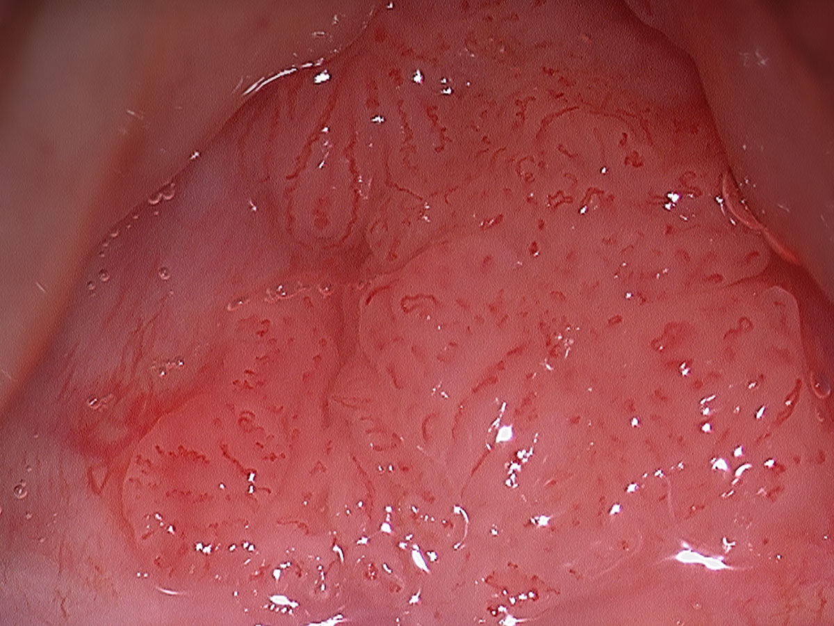 Queensland Voice Centre | Larynx and Throat Cancer