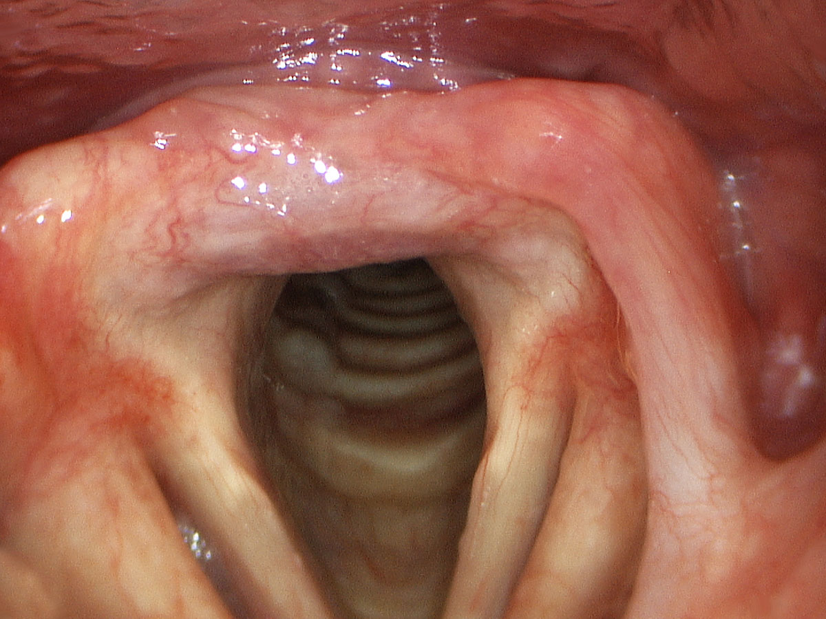 Hpv larynx papillomatosis. Papilloma of larynx