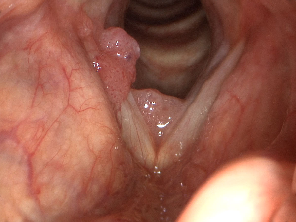 larynx papilloma causes