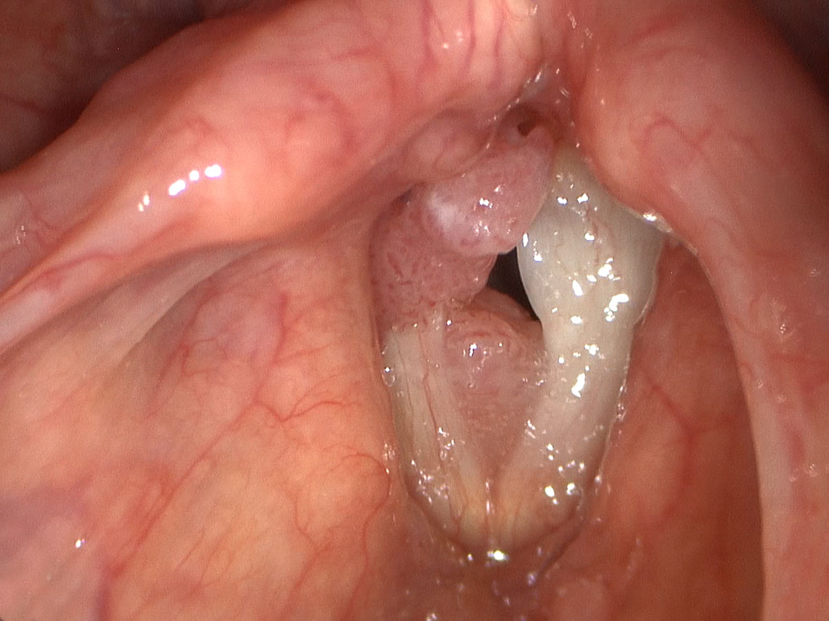 laryngeal papillomas cause